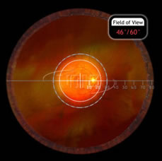 20D Double Aspheric Lens 52mm